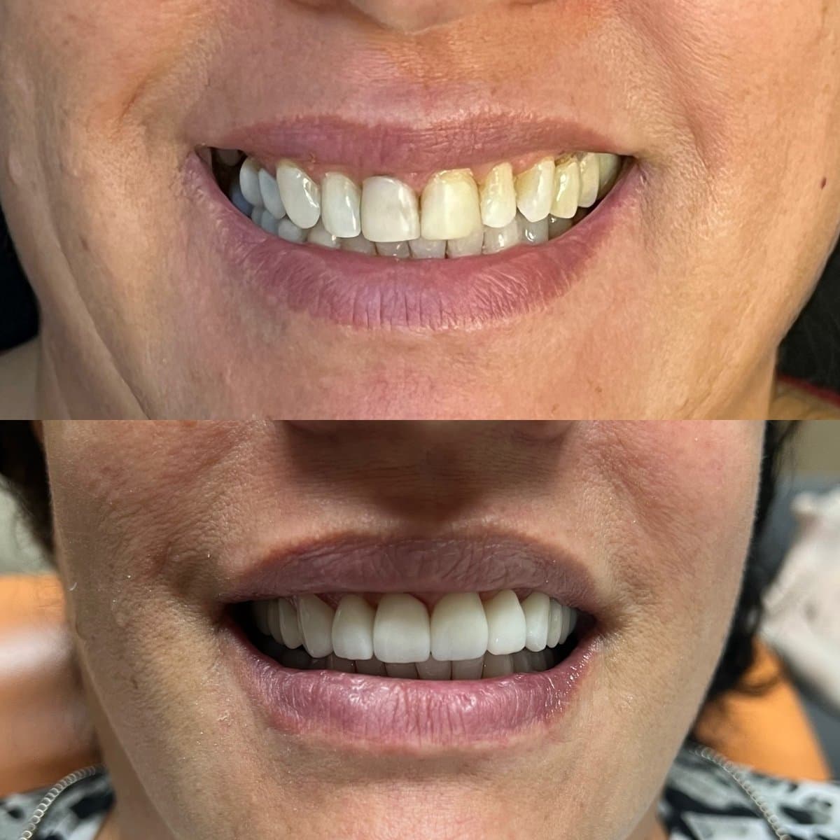 Antes e depois, Lentes de Porcelana